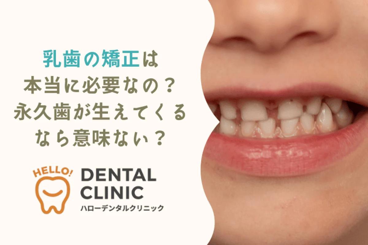 矯正 乳歯 見本 歯 歯学 hellodental-750-x-500-px-3-1.