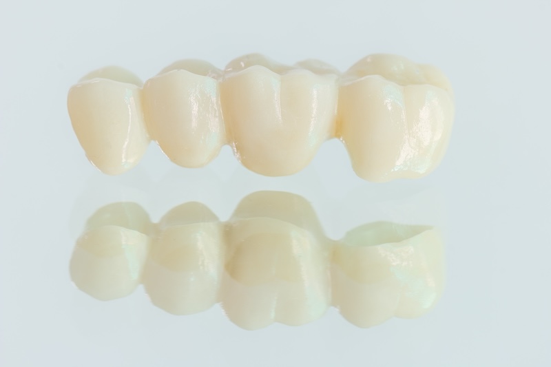 セラミック歯が完成するまでの期間はどれくらい？