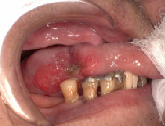 進行した舌癌で深いしこりと潰瘍がみられる