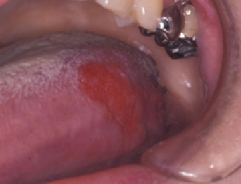 舌の紅板症（紅板症は初期癌、上皮内癌であることが多い）