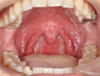 口腔カンジダ症（免疫が低下した時や、長期に抗生物質を投与されたときなどに、口の中にカビが繁殖する）