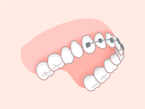 MTM(少ない歯数の歯並び改善)部分矯正