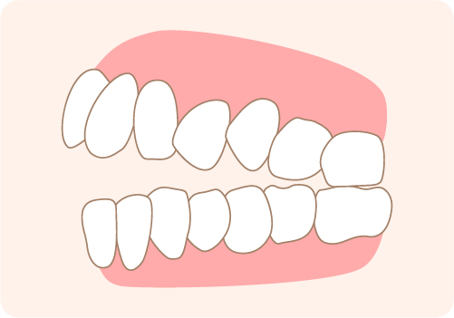 前歯が噛み合わない状態の歯並びについて