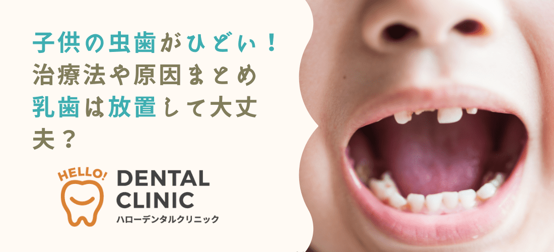 子供の虫歯がひどい！治療法や原因まとめ｜乳歯は放置して大丈夫？