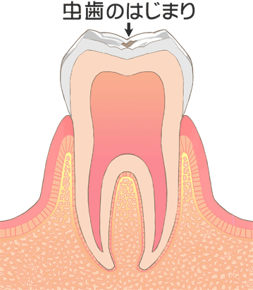 初期虫歯：C0