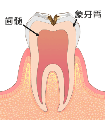 象牙質（ぞうげしつ）う蝕：C2