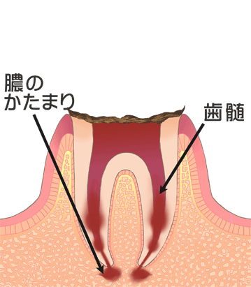 顎の骨に膿の袋ができる：C4