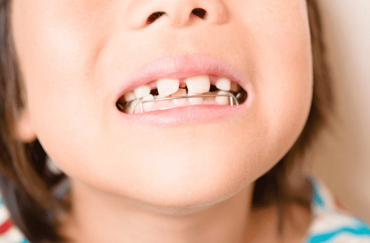 6歳よりも早く治療が必要となる子供の歯並び