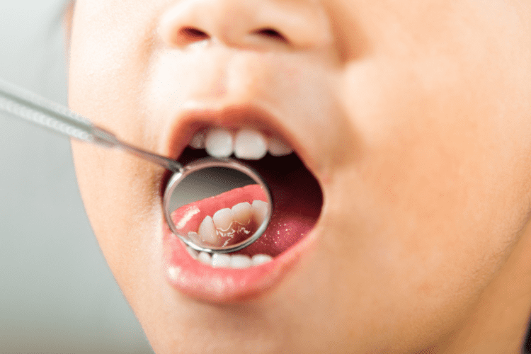 子供の乳歯の虫歯が神経まで広がった場合、神経を取り除くケースもあります