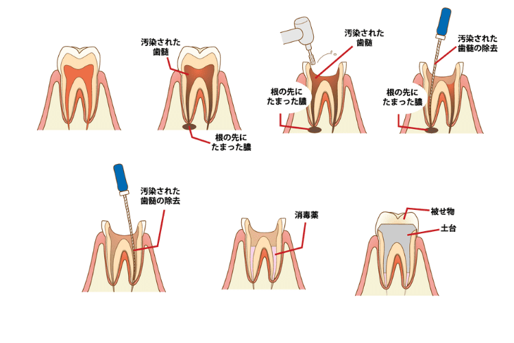 乳歯の根管治療の流れ