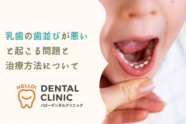 乳歯の歯並びが悪いと起こる問題と治療方法について