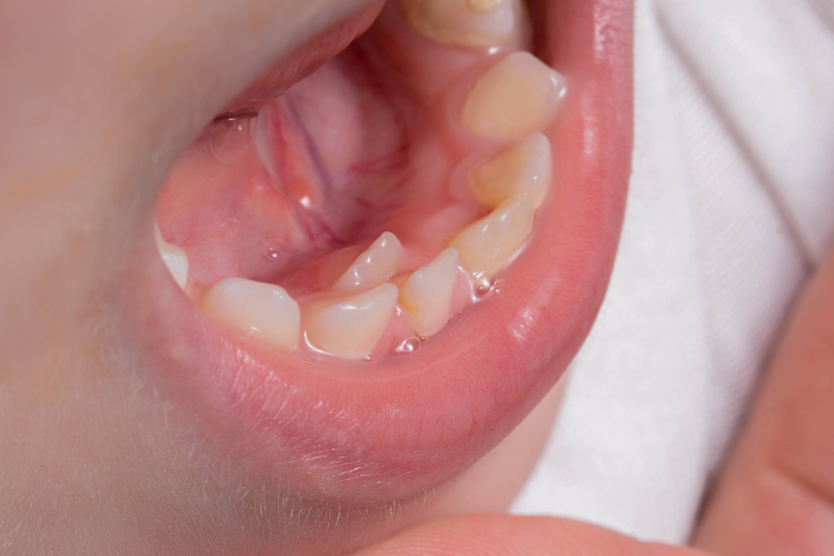 乳歯の歯並びが悪いと起こる問題について