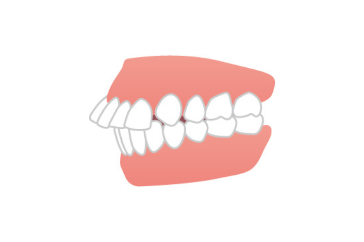 上顎前突（じょうがくぜんとつ）｜出っ歯のイラスト