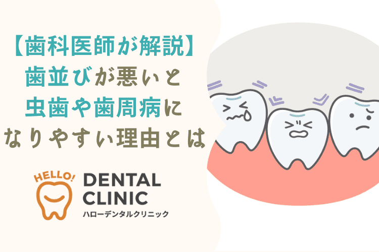 【歯科医師が解説】歯並びが悪いと虫歯や歯周病になりやすい理由とは